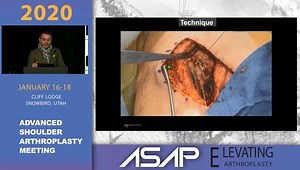 Latissimus Dorsi Transfer After Anatomic TSA for Subscapularis Failure