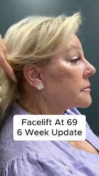 CO2 Laser Facelift At 69 - 6 Weeks Update #facelift