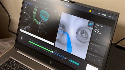 Florida hospital using robotics for lung cancer treatment