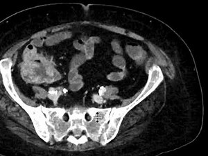 Metastatic Colon Cancer