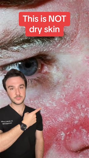 2.2K views | #seborrheic dermatitis #seborrhea #sebderm #dryskin Seborrheic dermatitis is a common skin condition that causes red, itchy, and flaky patches on the scalp, face, and other areas with an abu#260 | Dr. Casale | Facebook