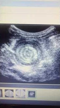 Ultrasound Intussusception Case by Radiologist