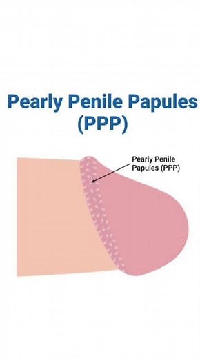 Pearly penile papules treatment !! Best homeopathic medicine for PPP !?
