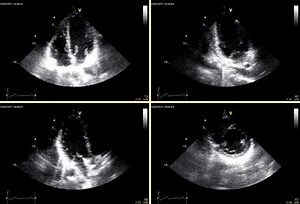 File:Left-ventricular-function-in-acute-inflammatory-peri-myocardial-diseases---new-insights-and-long-1476-7120-10-42-S1.ogv - Wikimedia Commons