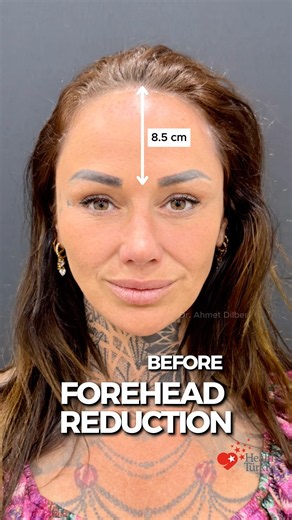 Forehead Reduction 💆🏻‍♀️ Dr. Ahmet Dilber 🌟 #foreheadreduction #hairlinelowering