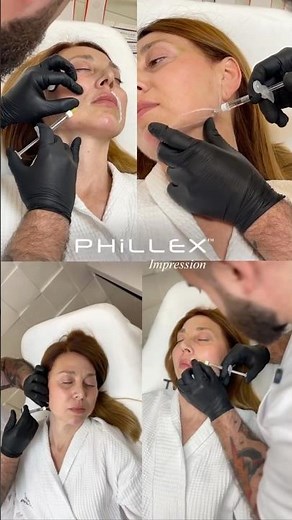 ✨ Phillex — When Do We Use Dermal Fillers?