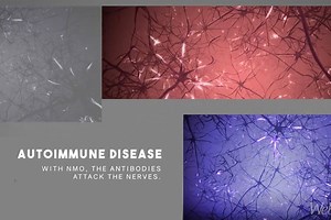 Focus on Neuromyelitis Optica vs. Multiple Sclerosis