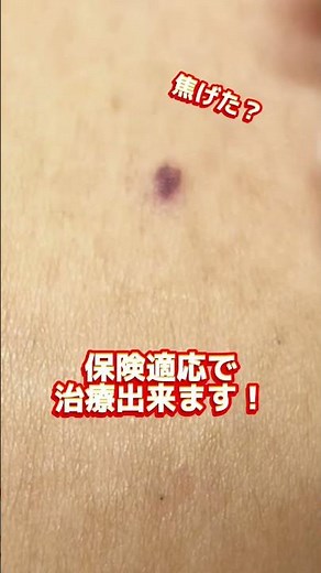この赤いポッチなに？！血管腫にレーザーを打つ瞬間#vビーム #血管拡張#手術