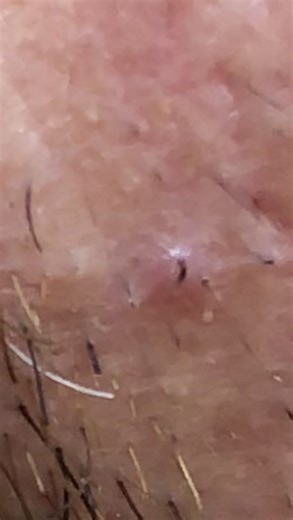 #fyp #foryou #viralvideo #ingrownhair #pelosencarnados #blackhead #내성발톱 #mọc_tóc #вросшийноготь #угорь #여드름 #黑头 #espinillas #wax #waxing #eingewachsenehaare #pertevideo #黑頭 #內包毛 #內崁