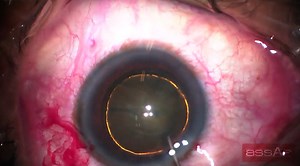 The Carousel Technique for Soft Cataracts - Eyetube