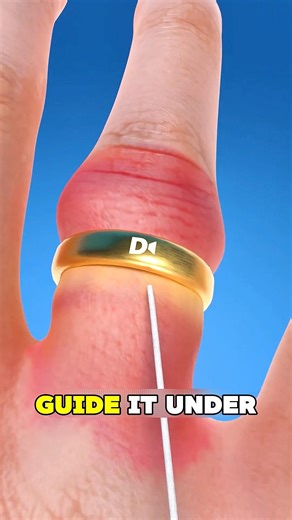 If Your Ring Gets Stuck on Your Finger, Do This Before It Turns Purple