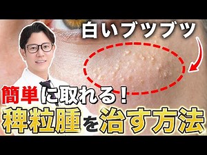 How to Treat Milia: Explained by a Japanese Dermatologist