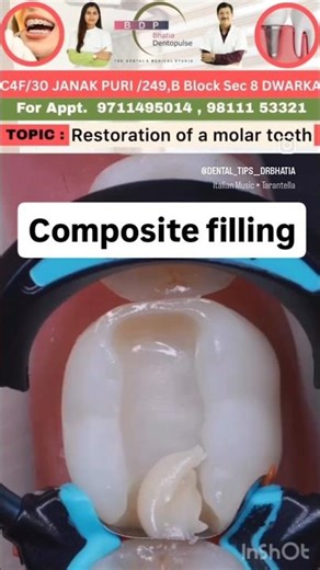 composite filling procedure in a accurate manner