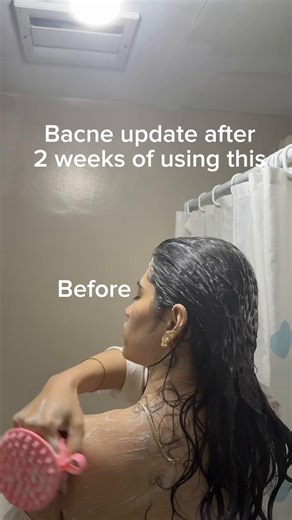 Effective Bacne Treatments That Work
