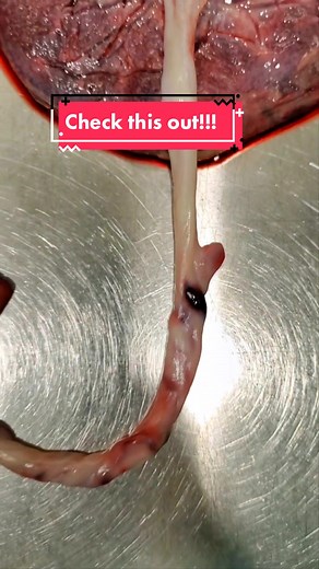Check out this false knot we saw today with this mama placenta! A false knot (or pseudoknot) is a very common variation in umbilical cords caused by extra looping of the blood vessels inside the whartons jelly. False knots do not have any clinical significance and can range in size 🥰 #placenta #placentatiktok #placentatok #placentaencapsulation #placentapills #placentaspecialist #viral #fyp #foryou #foryoupage #ppd #ppa #postpartumlife #postpartum #postpartumanxiety #postpartumdepresssion #post