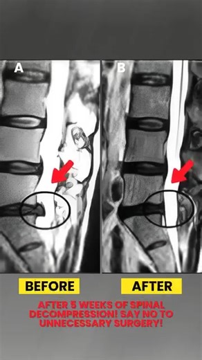 Winter Park, FL – Struggling with Back or Neck Pain? Get a Consultation with Our Medical Team! If you’ve been dealing with chronic back or neck pain, don’t wait for it to get worse. At Disc Centers of America Winter Park, we offer comprehensive, non-surgical solutions designed to help you get relief and restore mobility. For a limited time, we’re offering a Consultation with Our Medical Doctor, which includes: ✅ Comprehensive Exam With Our Doctor ✅ Muscle & Nerve Assessment ✅ MRI & X-Ray Review 