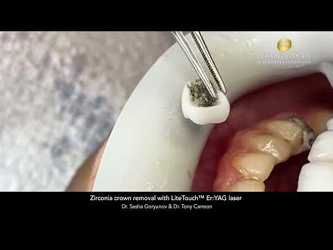 Zirconia crown removal with LiteTouch™ Er:YAG laser