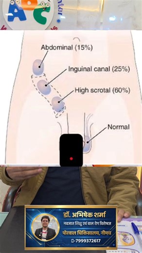 Dr.Abhishek Sharmaबच्चों का डॉक्टर 👨‍⚕️🩺👶. on Instagram: "“Undescended testis? Don’t worry — Orchiopexy can help. Here’s Dr. Abhishek Sharma with the facts.” #pediatricianlife #babycare #drabhisheksharma #parentingtips"