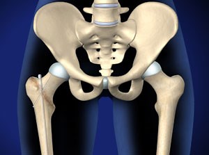 Femur Fracture Fixation with Intramedullary Rod Piedmont Orthopedics | OrthoAtlanta