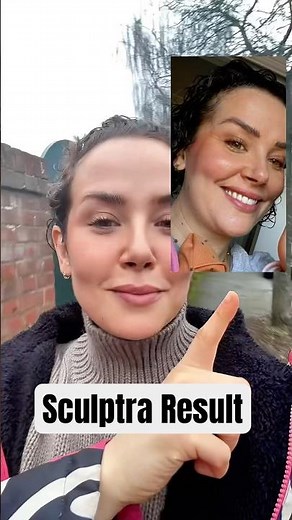 Sculptra Before & After Result