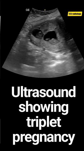 ultrasound showing triplet pregnancy# 3 babies developing in one uterus # pregnancy # ultrasound