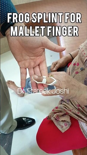 Frog Splint for Mallet Finger Injury #malletfinger #ortho #fracture #injury #accident #shorts