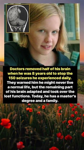 Half of His Brain Was Removed at Age 8