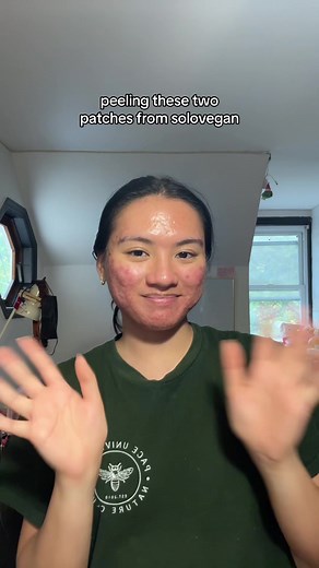 Patch Video Compilation | Pimple Patch Peel Offs & Removals