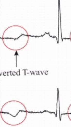inverted t wave ECG finding