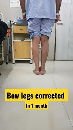 bow legs corrected