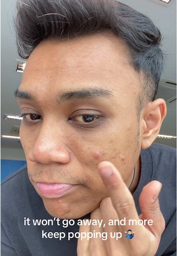 Acne Struggles: Effective Solutions for Clear Skin