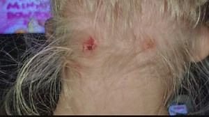 Are black fly bites a health concern?