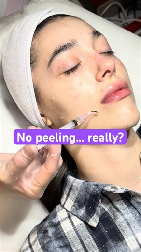 PRX peel no downtime | This peel just changed my skin #beauty #glowup