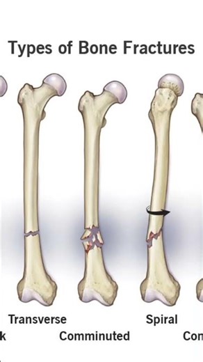 Types of fractures 🦴#bones