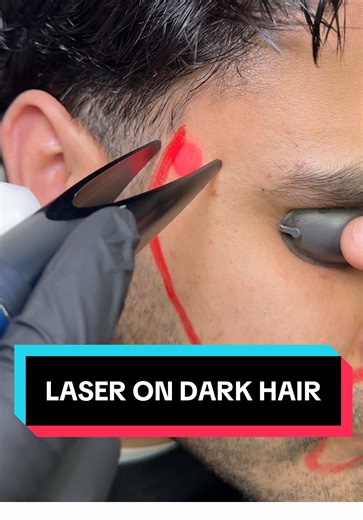 Laser hair removal targets pigment, that’s why dark hair gets better results. #laserhairremoval #hairremoval #mensgrooming #westyorkshire