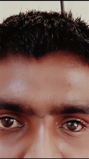 Artificial eye #youtubeshorts #ocularprosthesis #ocularist