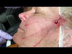 Three Vector PDO Threadlift Non-Surgical Facelift with VSoft Lift PDO Threads