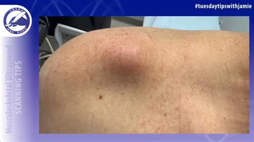 What’s causing this lump on the top of the shoulder? 🤔 That visible lump is often an AC joint cyst, most commonly caused by a chronic full-thickness rotator cuff tear — a classic finding known as the ✨ Geyser Sign ✨ 👇 Here’s what’s happening 👇 🔹 A long-standing rotator cuff tear disrupts the normal barrier that keeps joint fluid contained 🔹 Joint fluid escapes upward from the shoulder 🔹 The humeral head migrates superiorly and the AC joint capsule weakens 🔹 Fluid travels through the subac