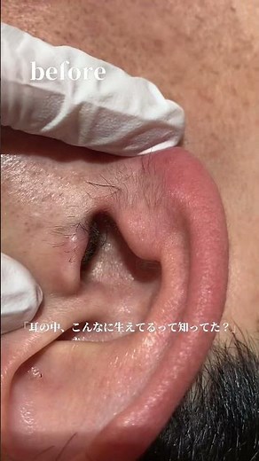 近距離で意外と見られています。今すぐ耳毛脱毛して！
