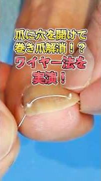 巻き爪の痛みを一瞬で解決！？巻き爪治療「ワイヤー法」を皮膚科専門医がセルフで実演！施術時間30秒、痛みのない治療を解説