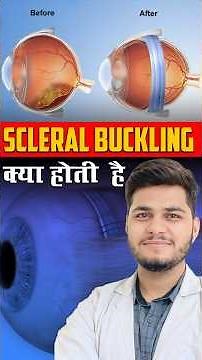 Scleral Buckle Surgery Step by Step | Eye Surgery for Retinal Detachment 🔴