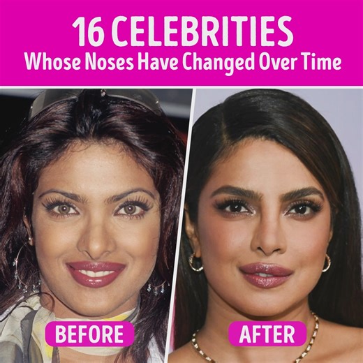 16 Celebrities Whose Noses Have Changed Over Time | Celestoria