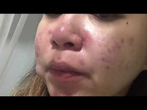 Before and after huge Cystic Acne bursted.