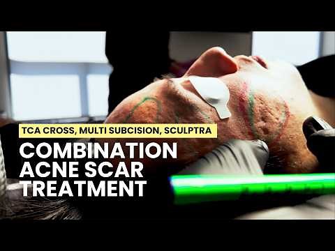 How to Treat Deep Acne Scars: TCA Cross, Subcision, Excision, CO2 Laser, Erbium Laser, Sculptra