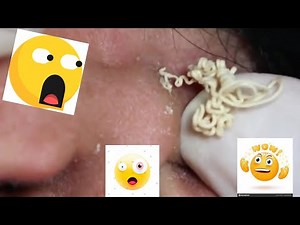 The LONGEST White Head Pimples, I have Ever Seen...EPIC/ RELAXATION VIDEOS...SOPHIA #19