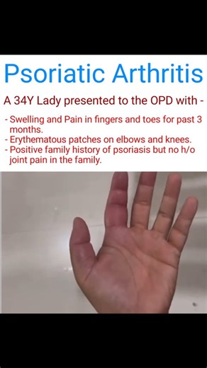 Dr Harsh Duhan on Instagram: "⏩️ Psoriatic Arthritis (PsA) PsA is a chronic inflammatory arthritis associated with psoriasis. It's an autoimmune disease affecting joints, entheses (where tendons/ligaments attach to bone), and sometimes other organs. It commonly occurs in those with a history of psoriasis, but can even precede skin changes. It's part of the seronegative spondyloarthropathies and can cause progressive joint damage if untreated. ⏩️ Pathogenesis The exact cause is unknown, but it in