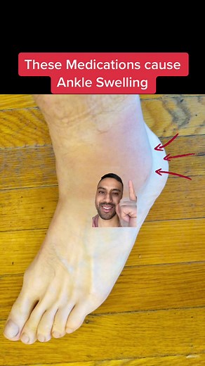 Doctor reveals medications that can cause ankle swelling or swollen legs. #fact #medication #sideeffects #swollen #medicaltiktok