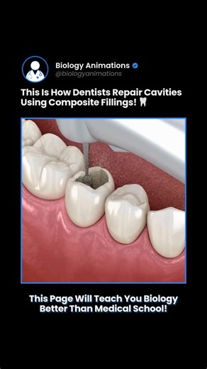 Biology • Science • Medicine on Instagram: "Composite dental fillings are a common tooth restoration procedure used to treat cavities and repair damaged teeth. This animation shows how dentists restore tooth structure after decay, helping prevent further damage and maintain oral health. The process begins by numbing the area and removing decayed tooth tissue to create a clean cavity. A composite resin filling is then placed in layers, shaped to match the natural tooth anatomy. Each layer is hard