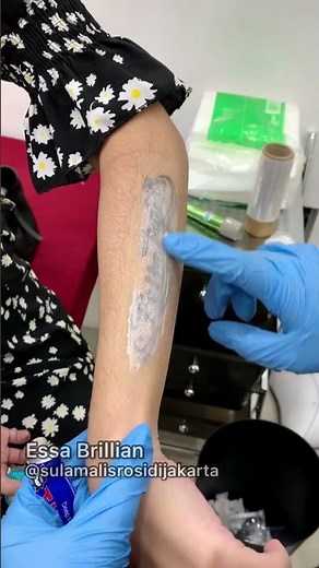 HAPUS TATTO MENGGUNAKAN LASER CANGGIH PART 1 #hapustatto #lasertattooremoval