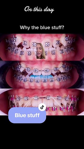 These are build ups! They can be used for a variety of reasons! In this case its to correct the overjet and then its removed #crossbite #braces